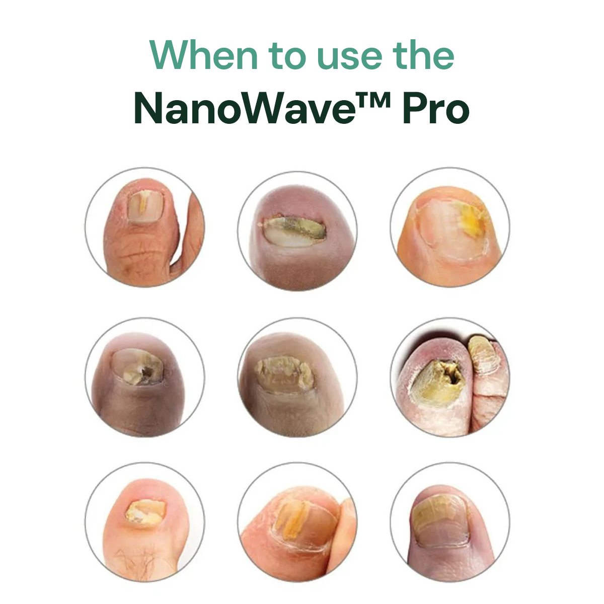 NanoWave Pro™ Anti-Fungal Blue Light Therapy
